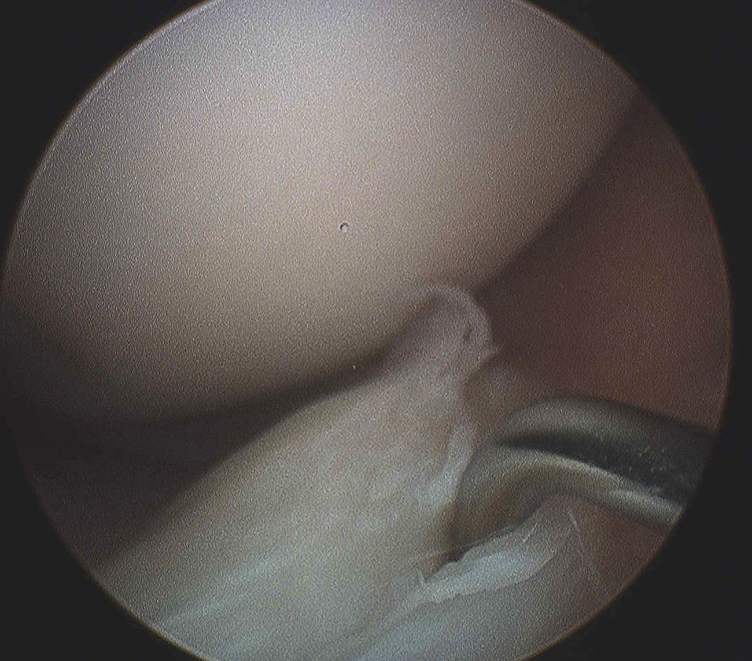 Anterior horn Meniscal Tear